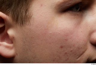 HD Face Skin Casey Schneider cheek face scar skin pores…